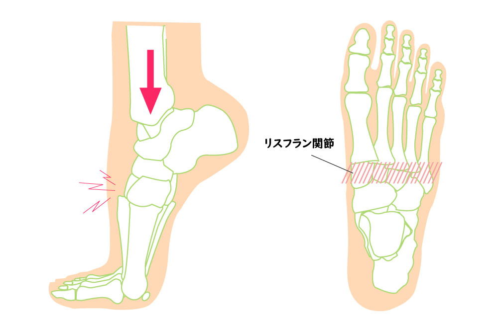 関節 ショパール