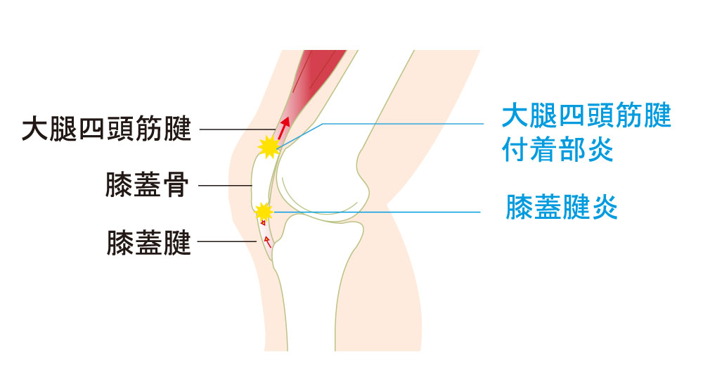 膝 曲げる と 痛い 突然