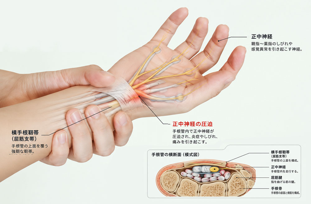 手根管症候群